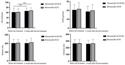 Synergistic effect of microneedle-delivered extracellular matrix compound and radiofrequency on rejuvenation of periorbital wrinkles